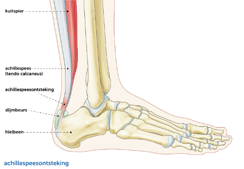 Achillespees Klachten Orthopedisch Centrum Vechtdal