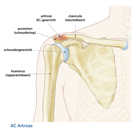 Roestig Verstelbaar tekst Orthopedisch Centrum Vechtdal - symptomen en klachten AC-gewricht