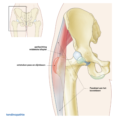 tendinopathie