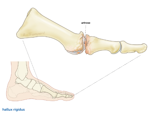 Hallux-Rigidus