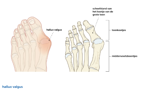 Hallux-Valgus