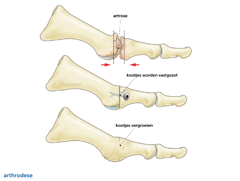 Arthrodese