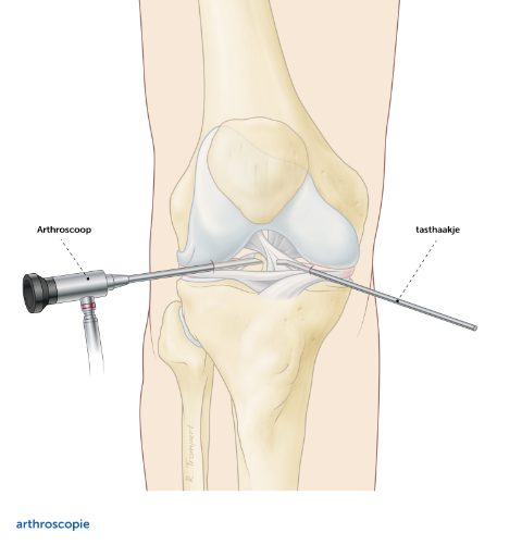 Arthroscopie