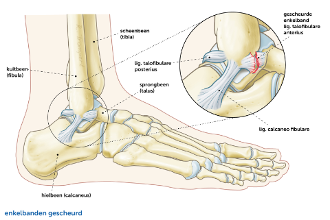 Enkelbanden-Gescheurd