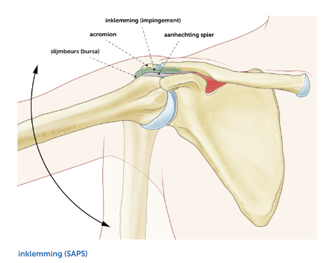 Subacromiaal-Pijnsyndroom-impingement