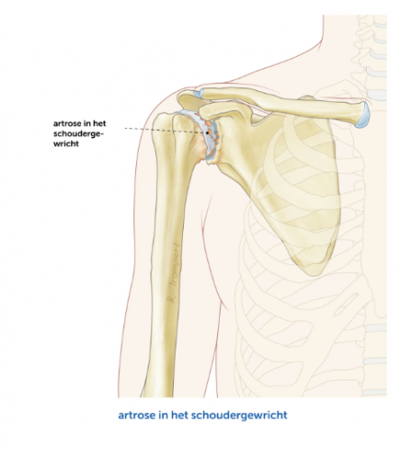 Artrose-Schouder