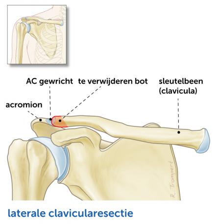 Laterale-clavicularesectie