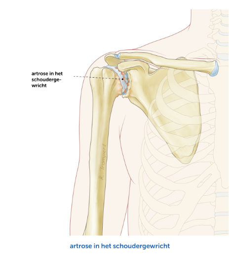 Artrose-Schouder