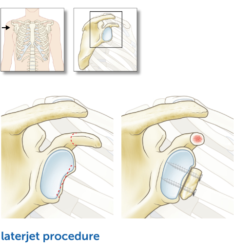 Laterjet-Procedure