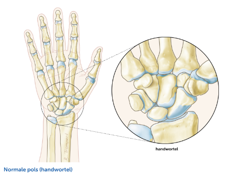 Artrose van pols | Orthopedisch Centrum