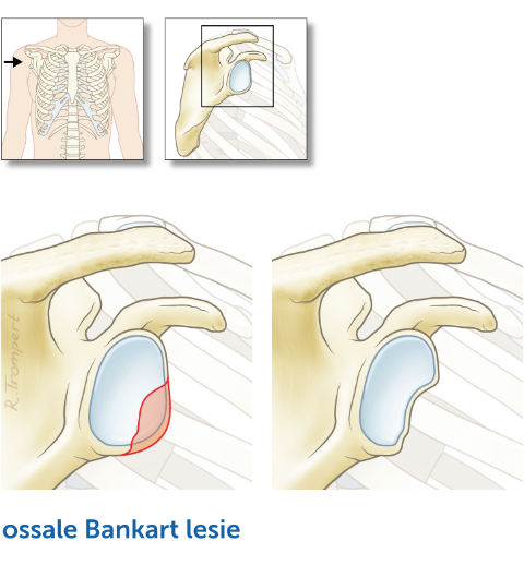 Bankart-lesie