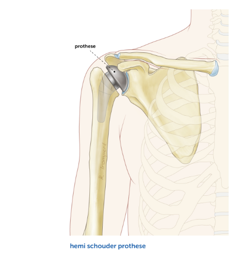 Schouderprothese-hemi-schouderprotheses